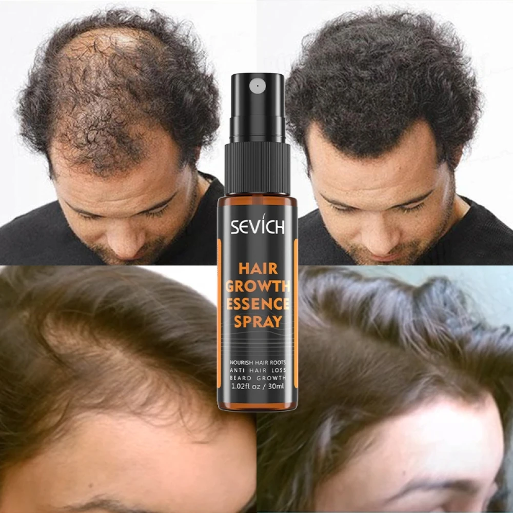 SEVICH Hair Growth Spray + Microneedling Roller,Fragrance Free Pure Natural Hair Care Essence for Men & Women {গ্রোথ এসেন্স স্প্রে সাথে ডার্মা রোলার ফ্রি}